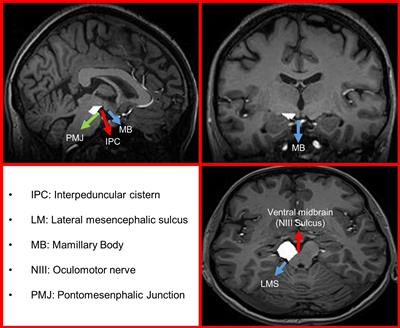 Investigating the Association of Wallerian Degeneration and Diaschisis After Ischemic Stroke With BOLD Cerebrovascular Reactivity